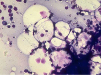 Normal Fat cells in Bone Marrow Aspirate
