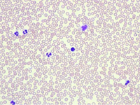 Blood Image of Iron Deficiency Anemia