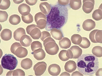 Blood Image of Virus affected lymphocytes