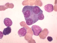 Plasma cells in Myeloma, a type of bone marrow cancer