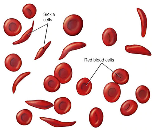 Red Blood Cells distinguished from Sickle Cells